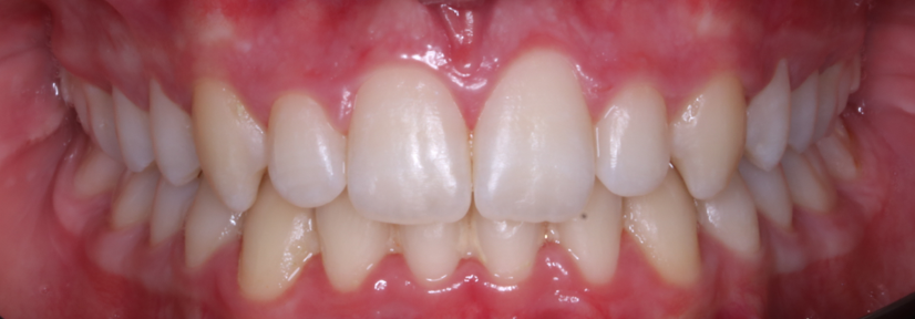 FRONTAL